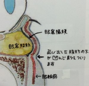 下まぶたと眼窩脂肪