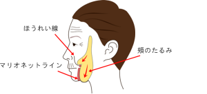 バッカルファットの下垂